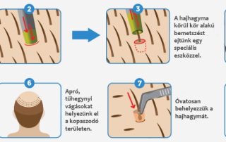 FUE hajbeültetési technika bemutatása inforgrafikán