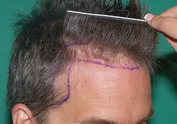 Hajvonal kialakítása a hajszálhiján klinikán, ahogy a képen látható, oda kerül majd a haj beültetésre