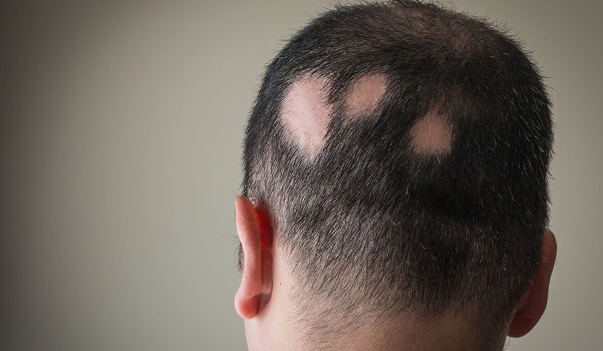 alopecia areate más néven foltos hajhullás